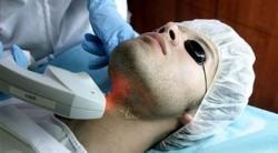 foto de depilação a laser em homem
