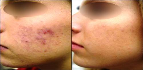 foto cicatriz de acne