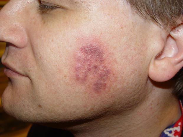 cicatriz de acne manchas