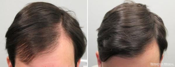 minoxidil calvicie antes e depois