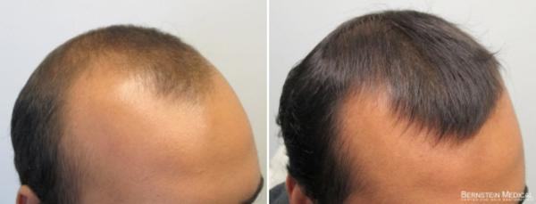 minoxidil calvicie antes e depois