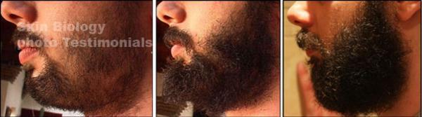 minoxidil crescer barba antes e depois
