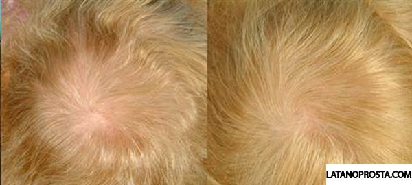 latisse-alopecia-areata